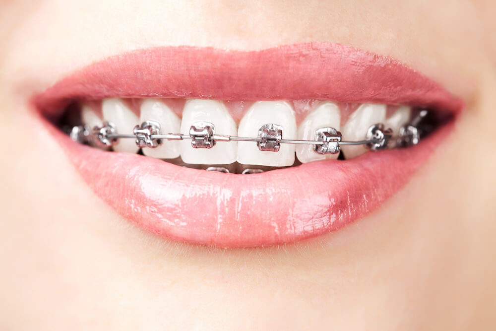 How To Handle Poking Wires & Broken Brackets Camellia Orthodontics